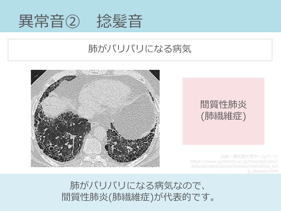 水泡音と捻髪音はどんな音 原因疾患は 呼吸音は4種類で十分 コキュトレ