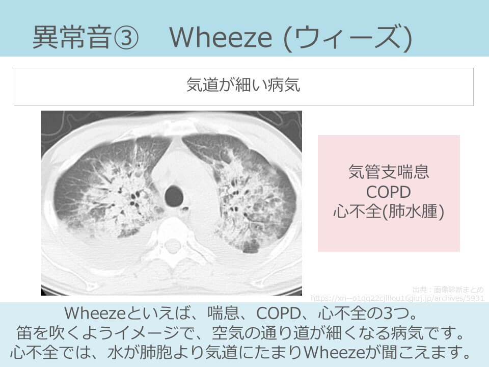 異常呼吸音 副雑音 の種類とアセスメント ナース専科
