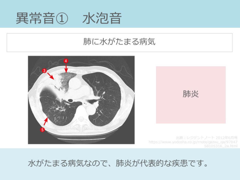 水泡音は、低音、断続性、吸気メイン。原因疾患は肺炎