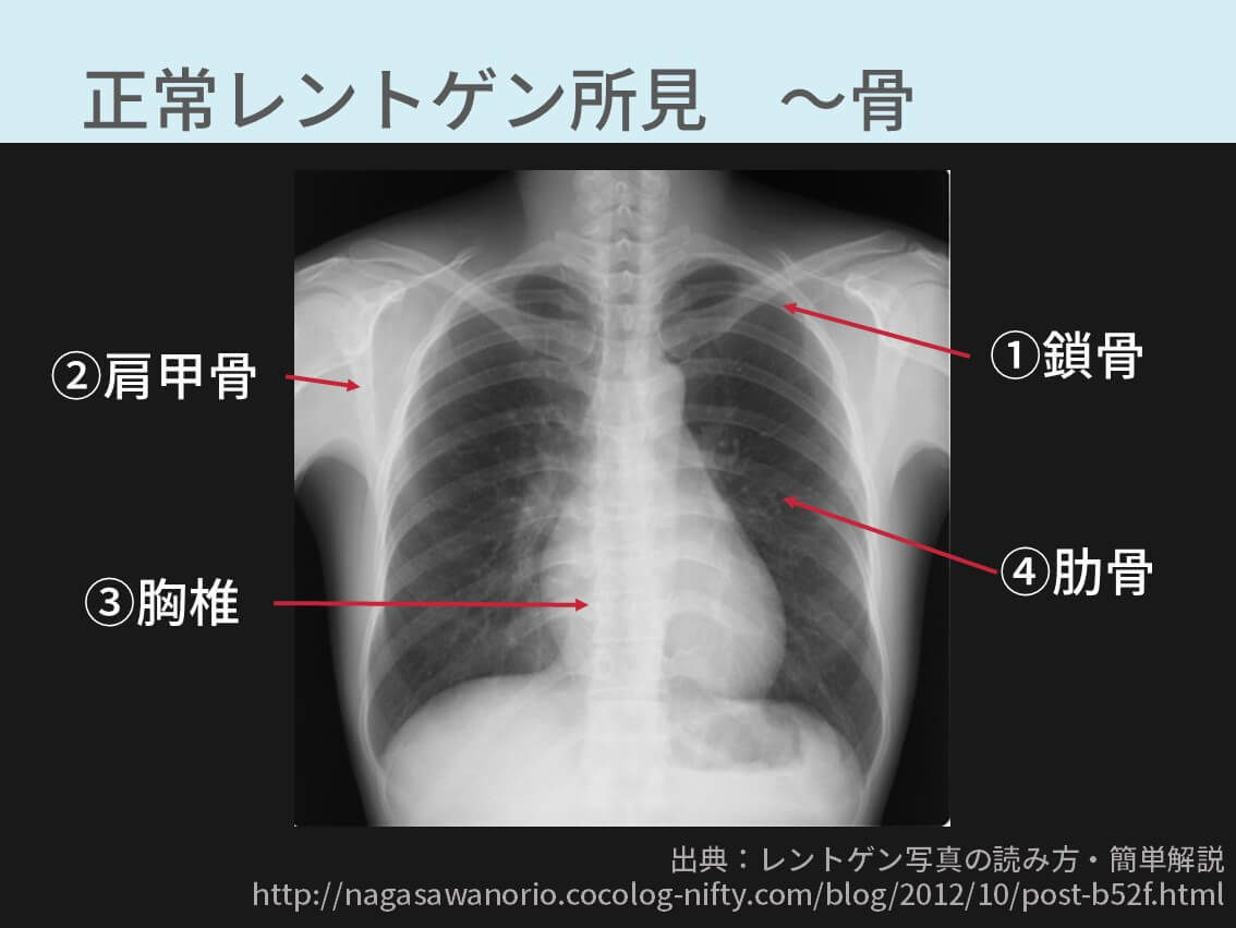 胸部レントゲンの正常所見14選 10年目呼吸器内科医が解説 コキュトレ