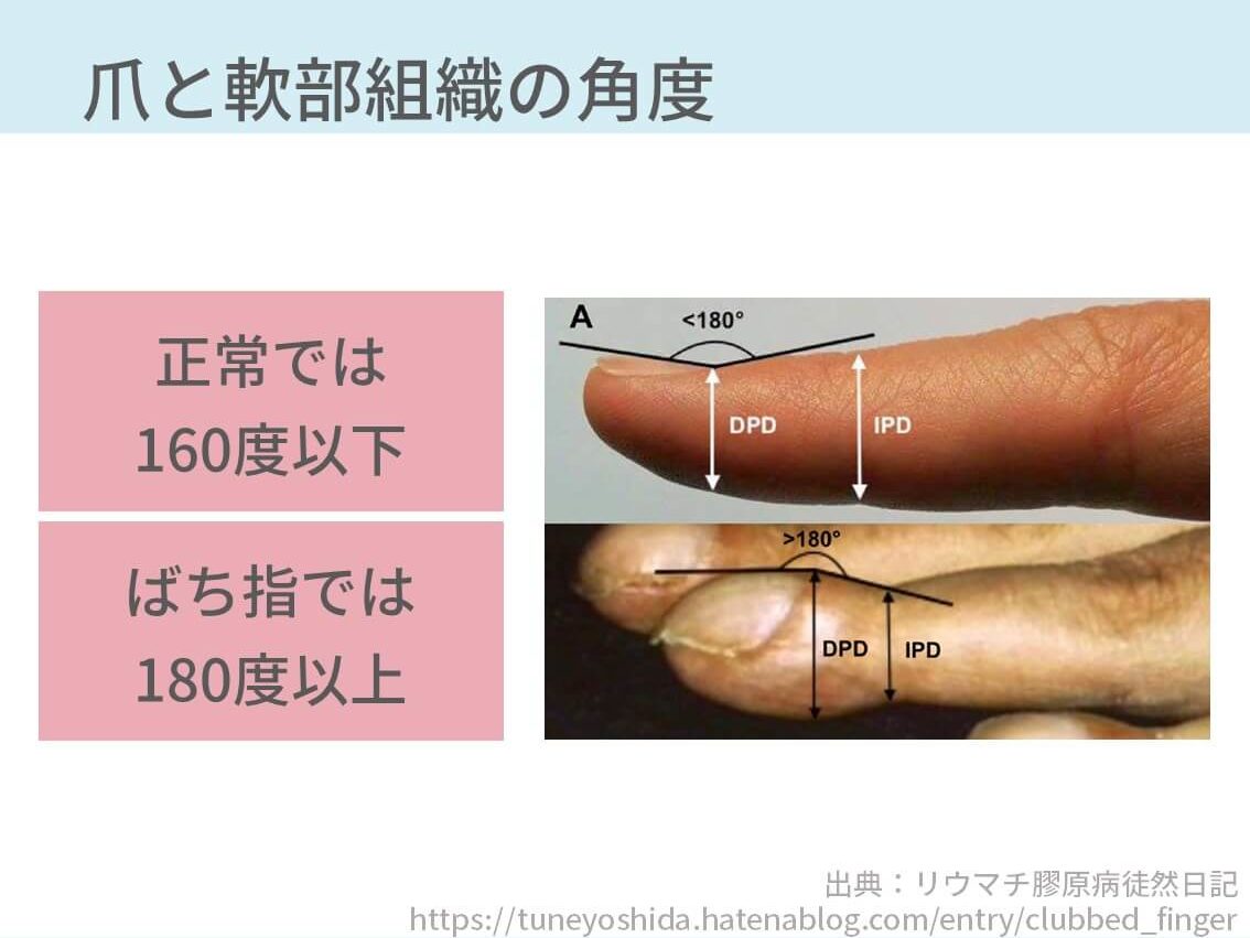 ばち指の見分け方3選 画像付きで解説 原因疾患も併せて学べます コキュトレ