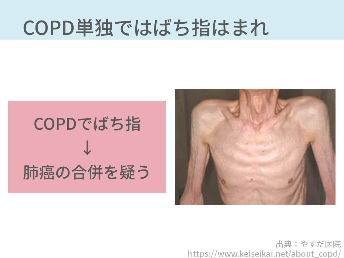 ばち指の見分け方3選 画像付きで解説 原因疾患も併せて学べます コキュトレ