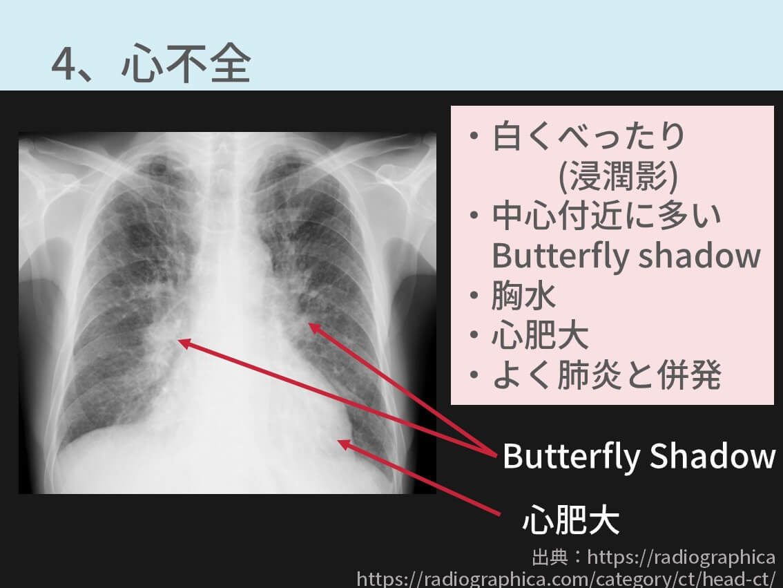 胸部レントゲンの異常所見まとめ 保存版 重要な疾患7つを解説 コキュトレ