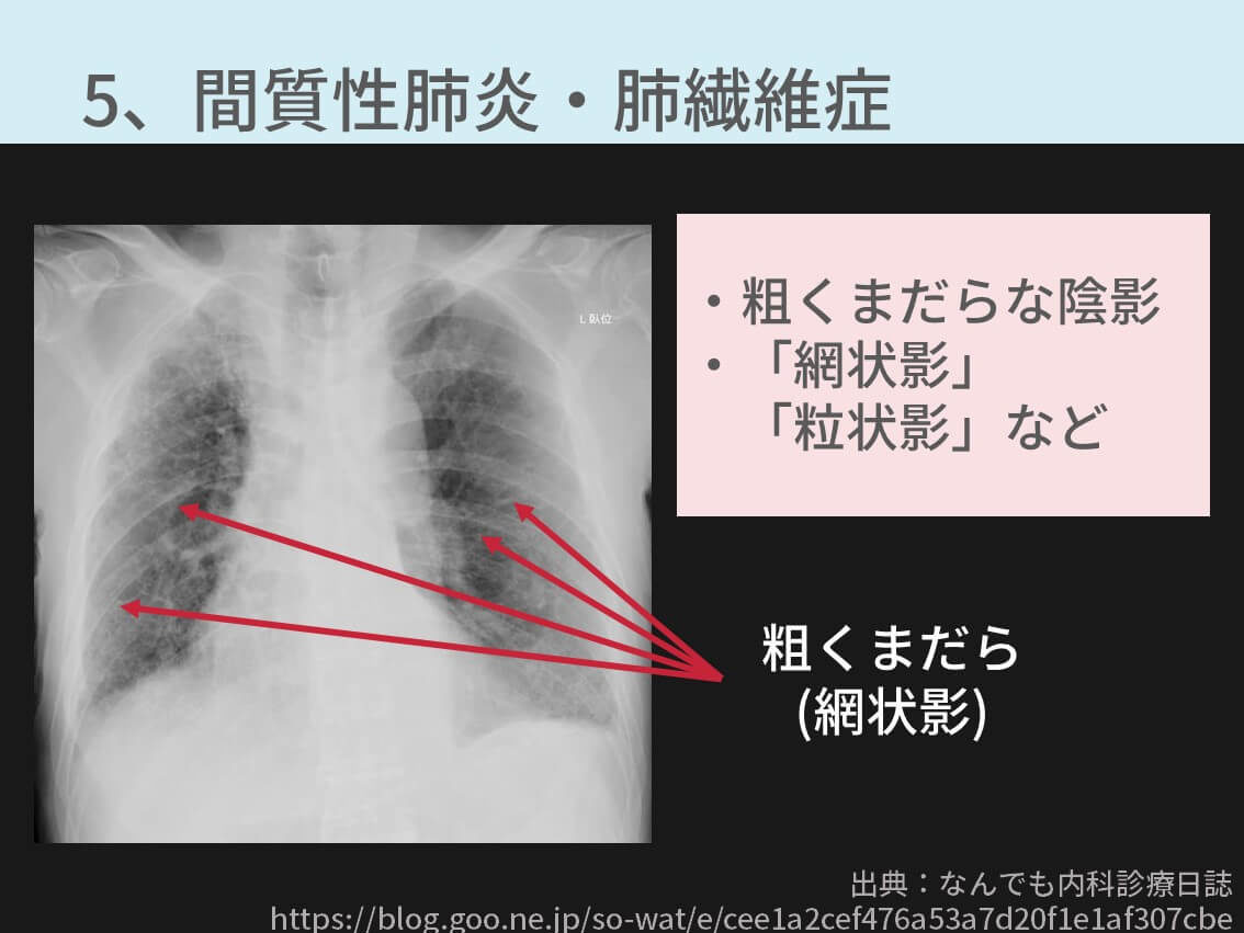 胸部レントゲンの異常所見まとめ 保存版 重要な疾患7つを解説 コキュトレ