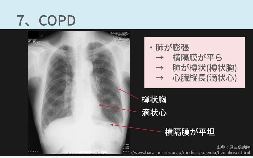 胸部レントゲンの異常所見まとめ 保存版 重要な疾患7つを解説 コキュトレ