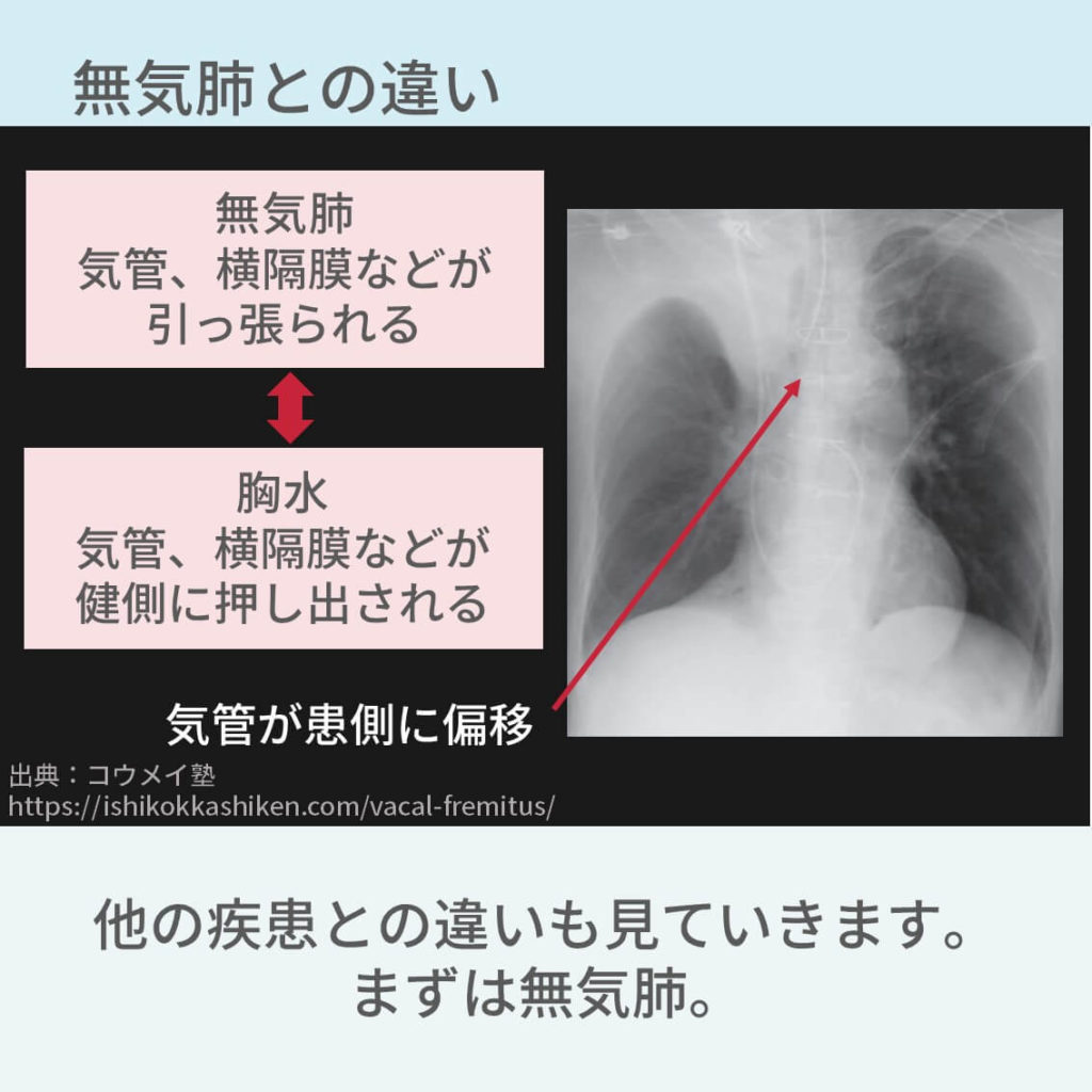 胸部レントゲンのポイント総まとめ スライドで解説 コキュトレ