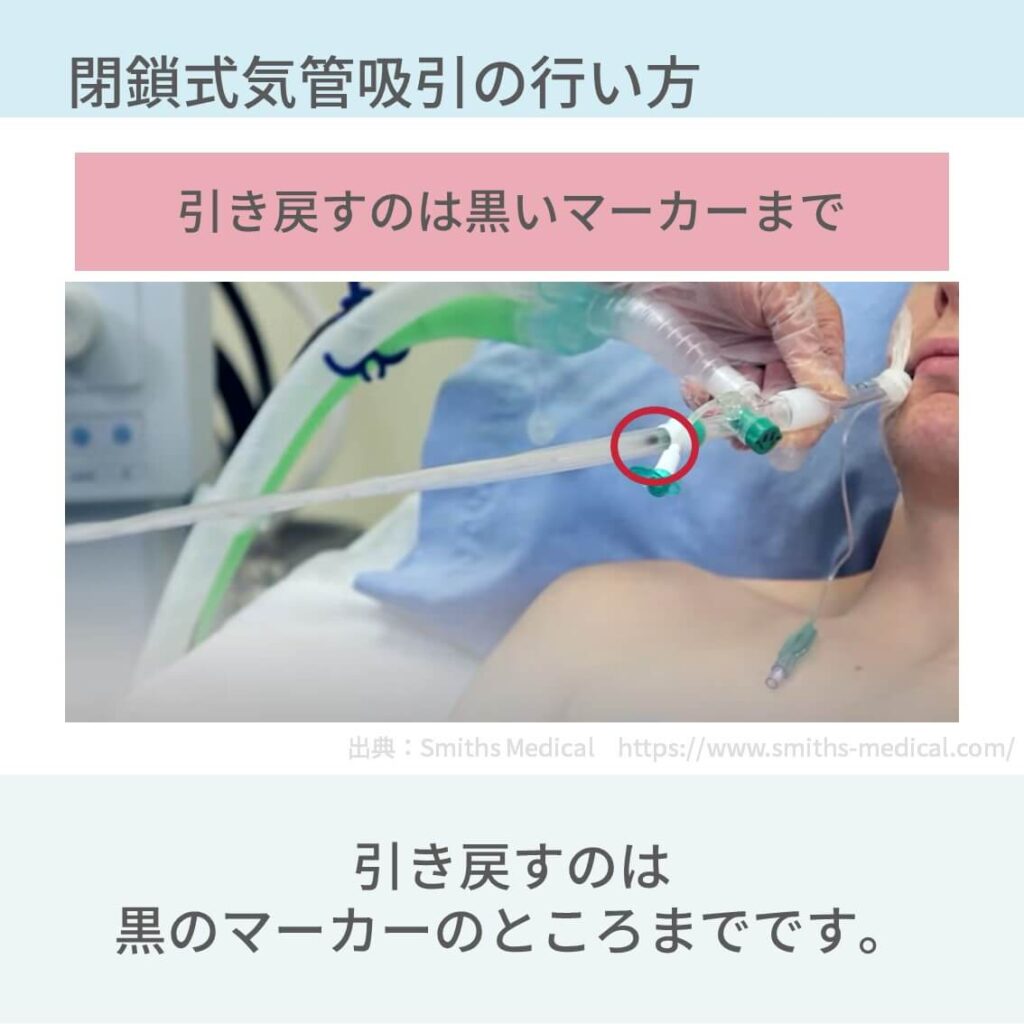人工呼吸器、気管吸引