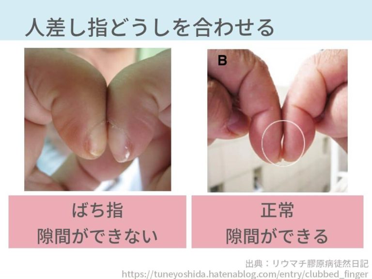 第一関節と第二関節の太さを比べる