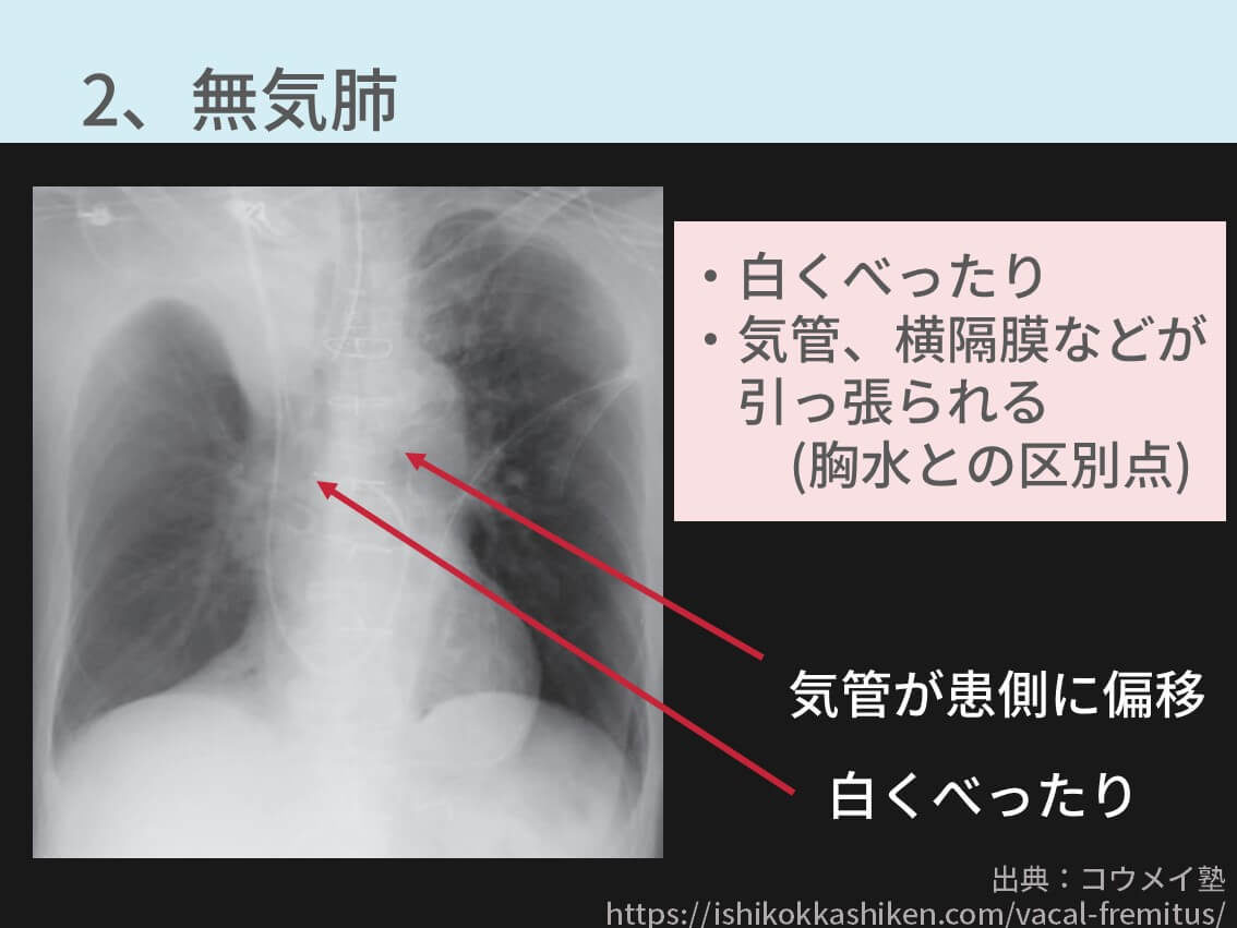 無気肺とは何ですか?