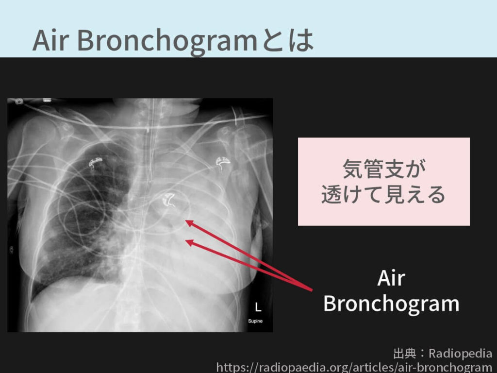 胸部レントゲン、Air Bronchogram