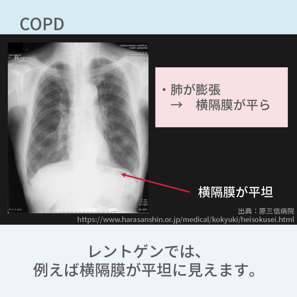 胸部レントゲン、COPD