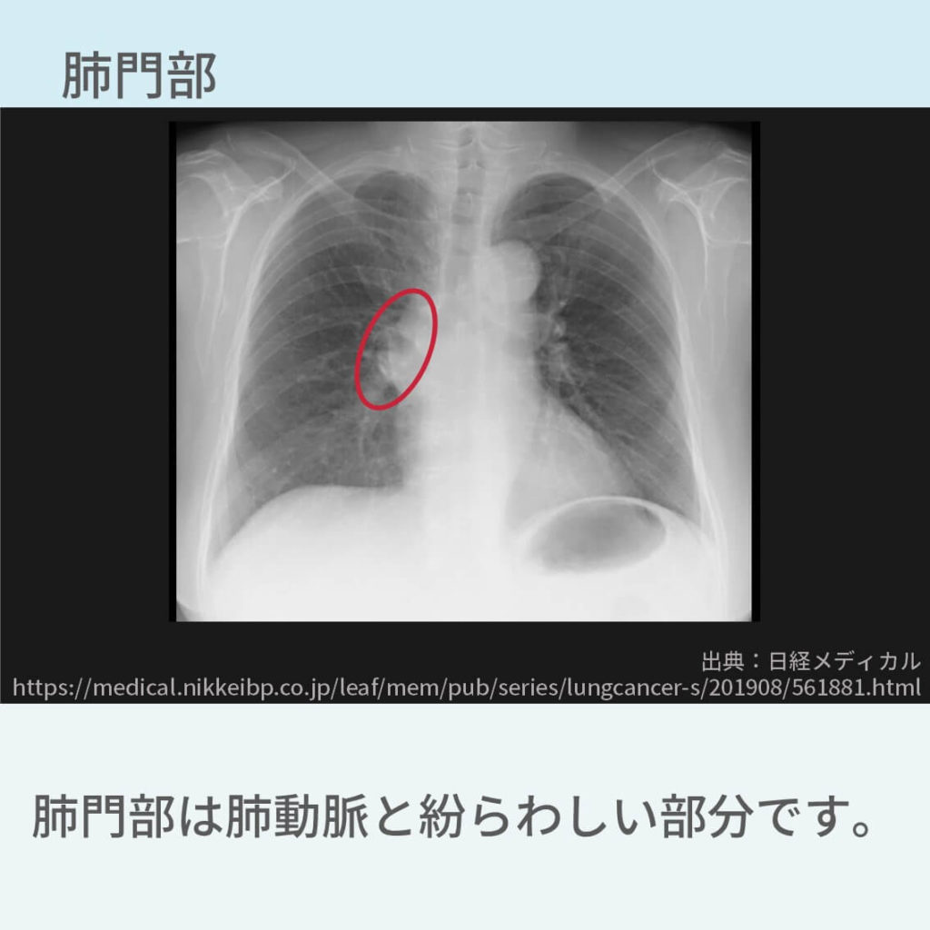 胸部レントゲン、肺癌