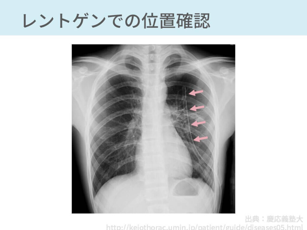 胸腔ドレナージ 手技 合併症 気胸 胸水 膿胸 血胸