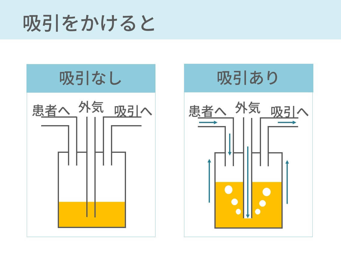 胸腔ドレーンバッグの仕組み 呼吸性移動とエアリークも解説 コキュトレ