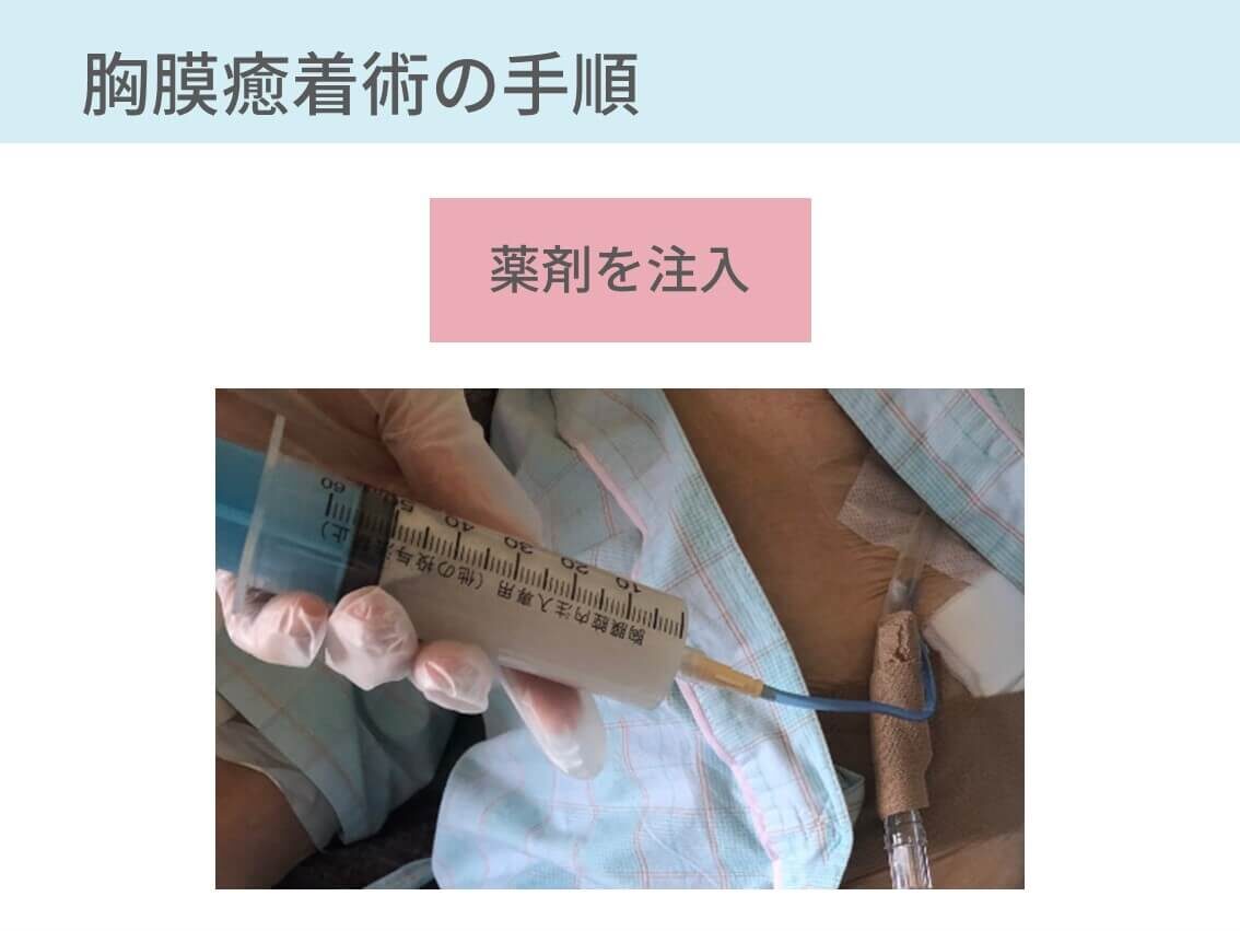 胸膜癒着術の手技 看護計画を解説 薬剤や副作用も併せてまとめました コキュトレ