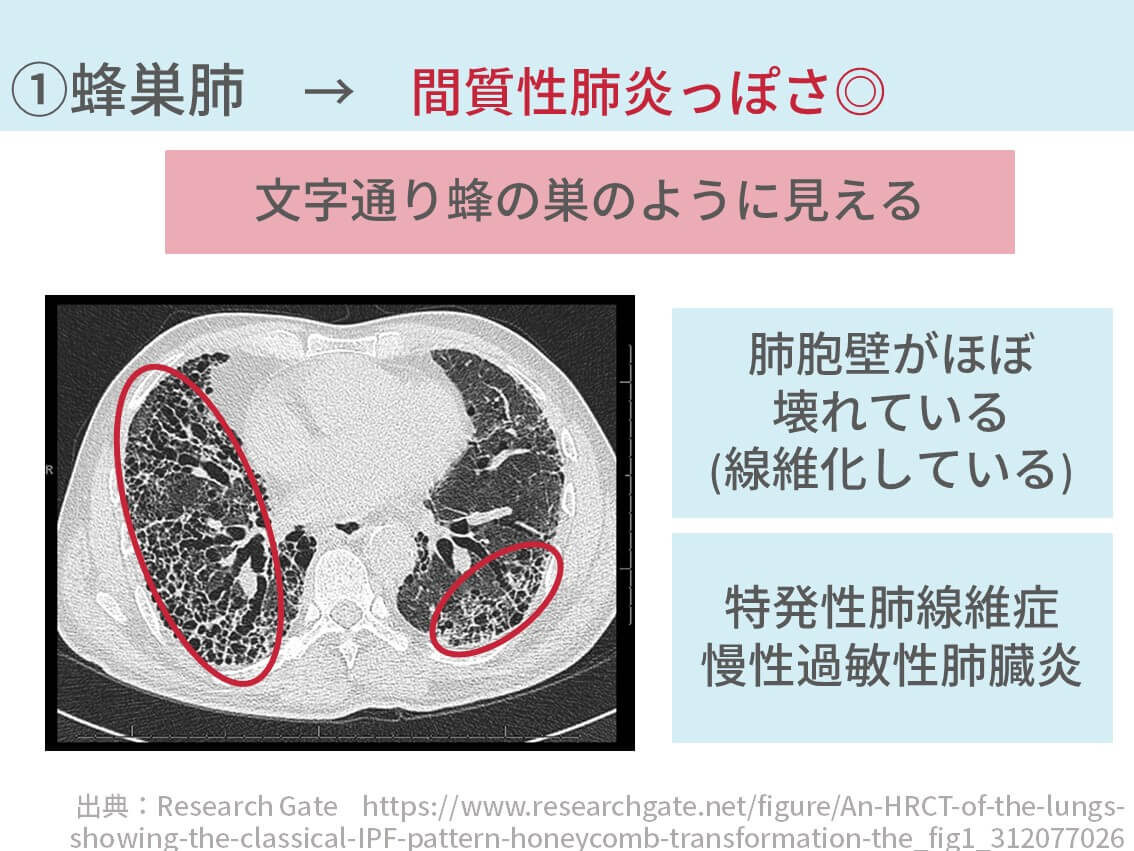 間 質 性 肺炎 と は