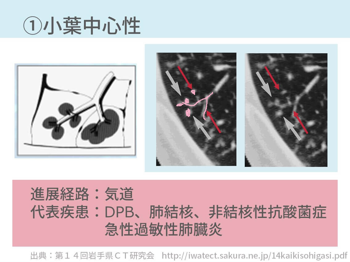 胸部ctで二次小葉から原因疾患を判断する方法 4つに分ければ理解できる コキュトレ