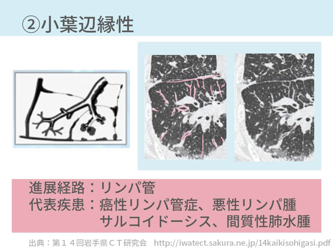 胸部ctで二次小葉から原因疾患を判断する方法 4つに分ければ理解できる コキュトレ