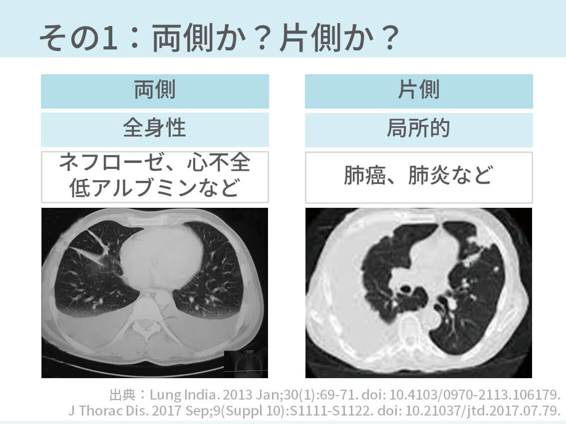 胸部CT、胸水