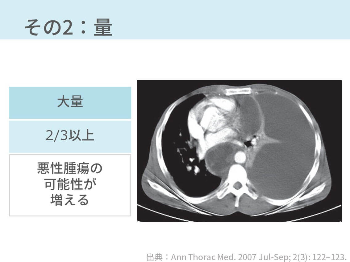 胸部CT、胸水