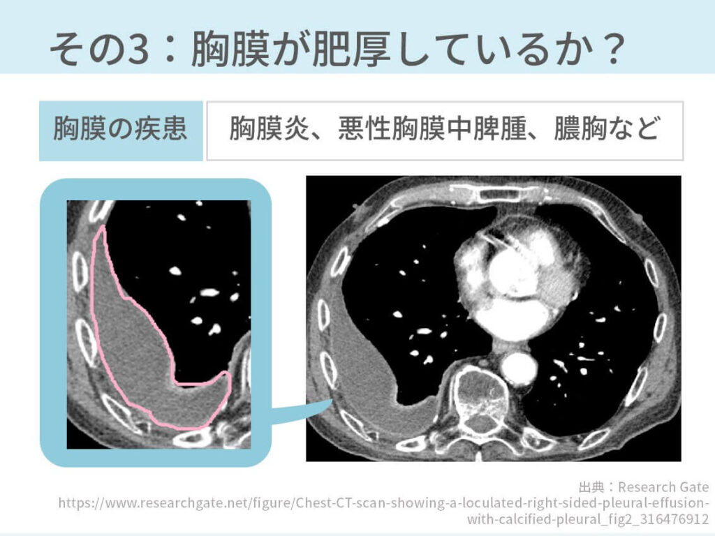 胸部CT、胸水