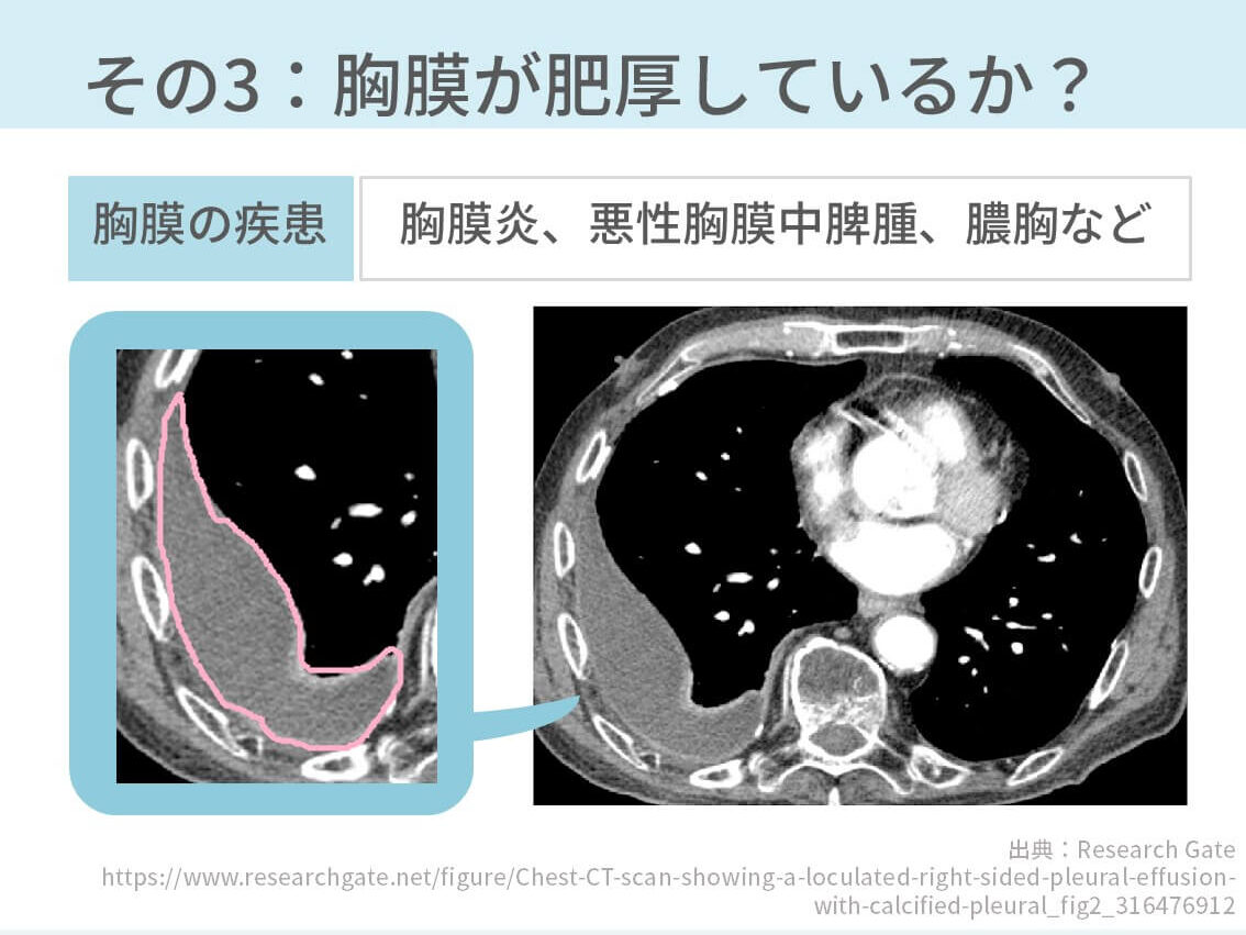 さらに詳しく見たい人は[ 胸部CTで二次小葉から原因疾患を判断する方法【4つに分ければ理解できる】 ]も参考にしてみてください。