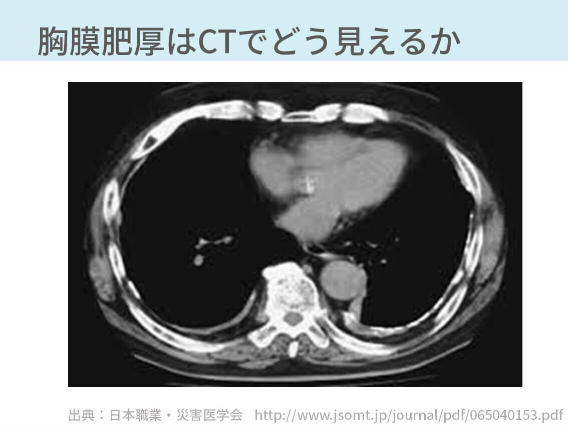 胸膜肥厚画像, 胸膜肥厚 治療 – GJTU