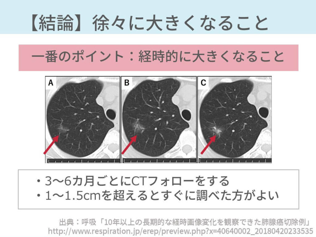 胸部CT、肺癌