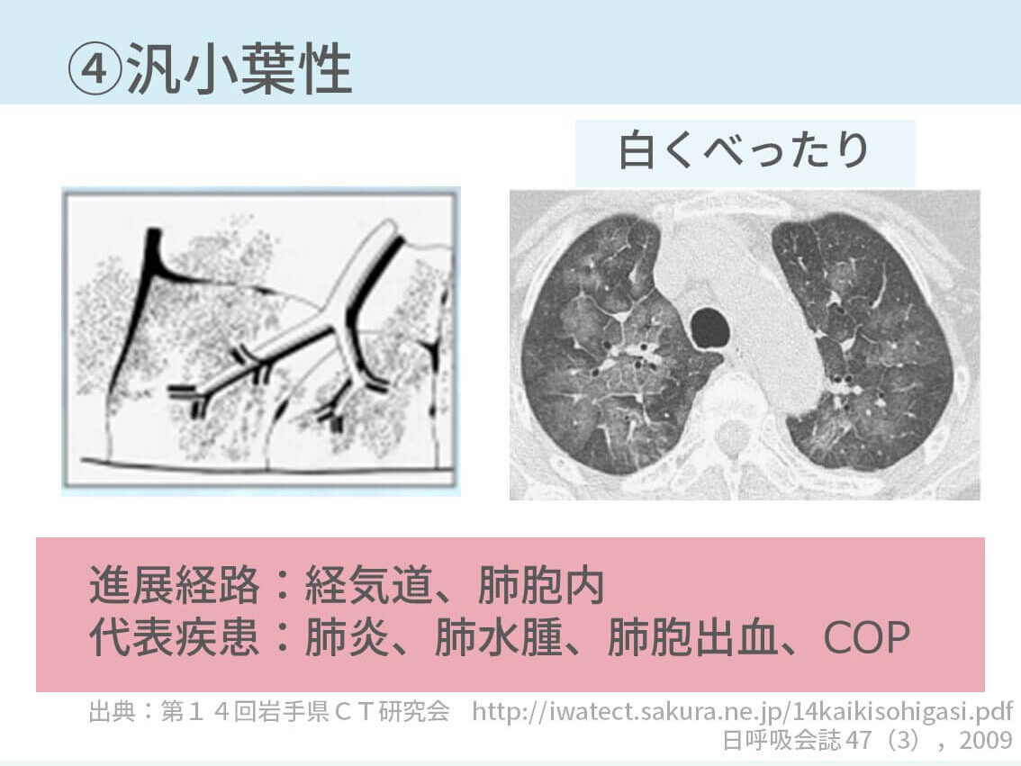 胸部CT、二次小葉、小葉中心性、小葉辺縁性、ランダム性、汎小葉性
