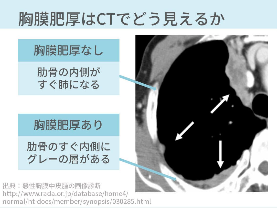 胸部CT、胸膜肥厚