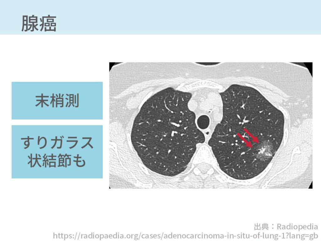 胸部CT、肺癌