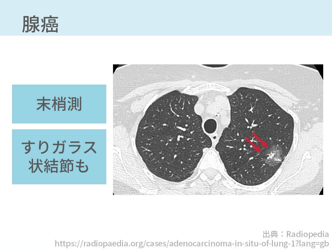 胸部CT、肺癌
