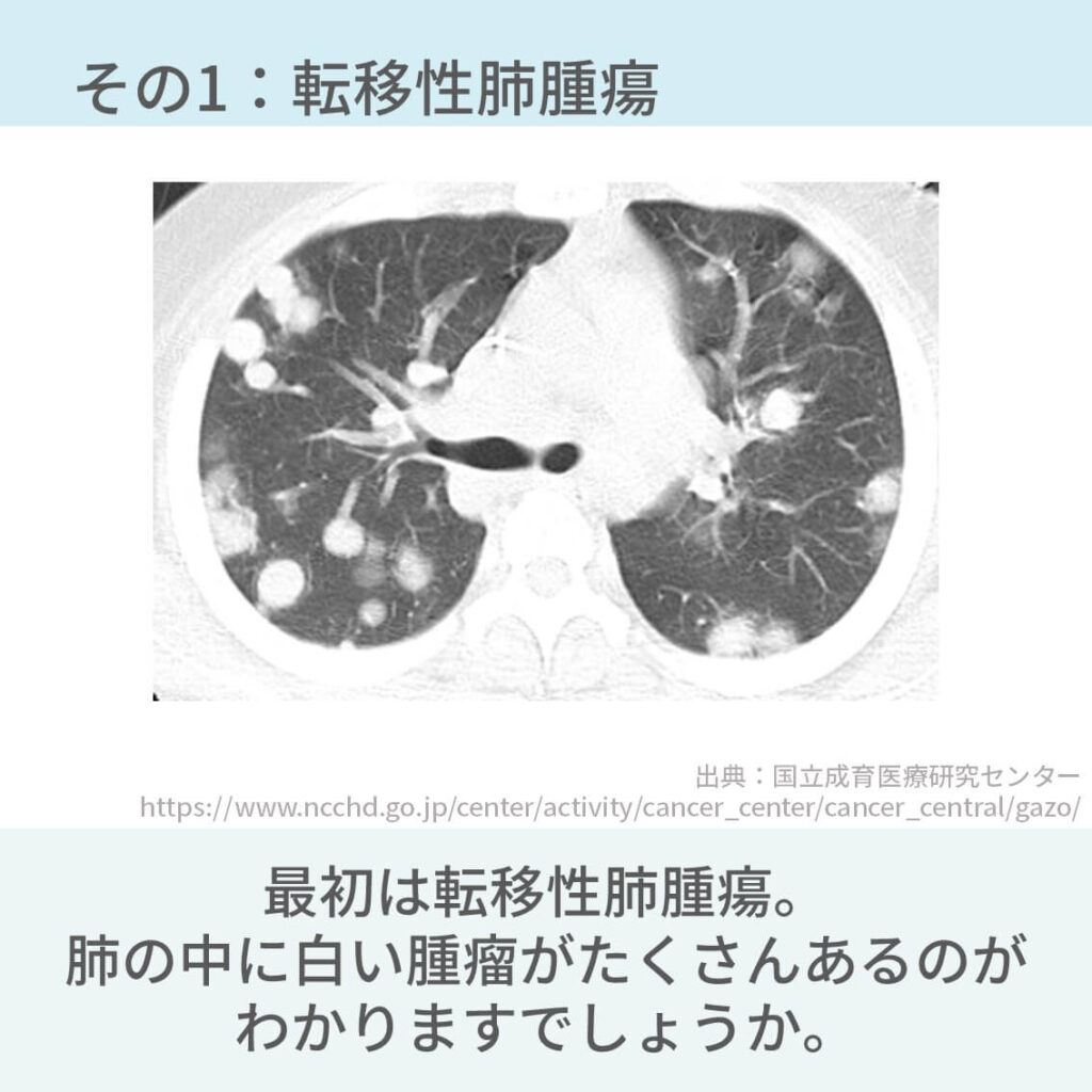 胸部CT、多発腫瘤