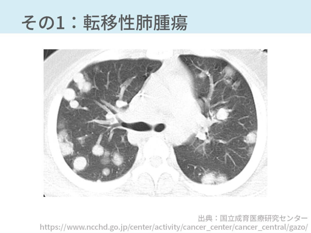 胸部CT、多発腫瘤