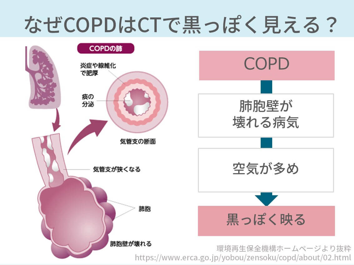 胸部CT、COPD