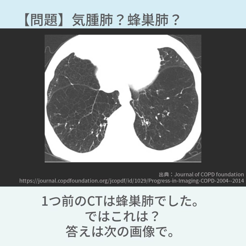 胸部CT、COPD