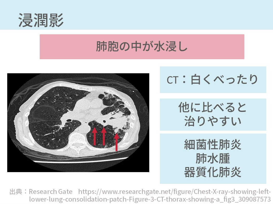 胸部CT、間質性肺炎、びまん性肺疾患