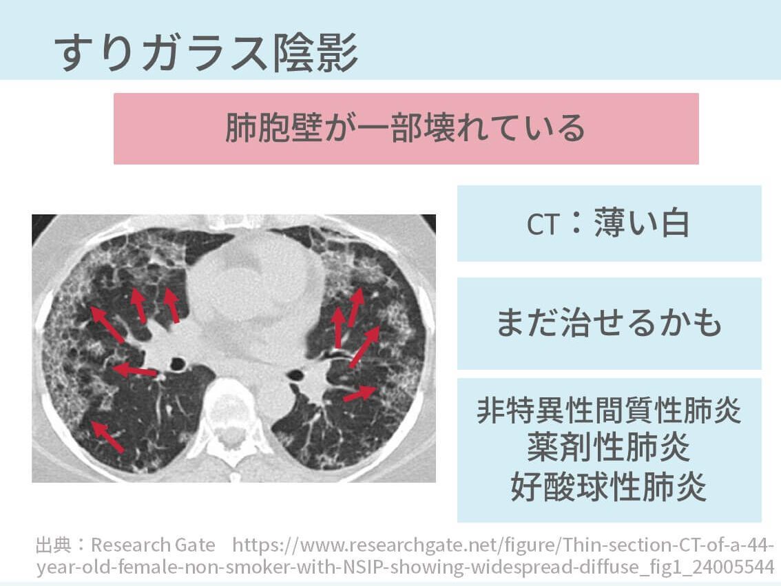 間質性肺炎の胸部CTの所見【悲報：胸部CTからは診断できません 