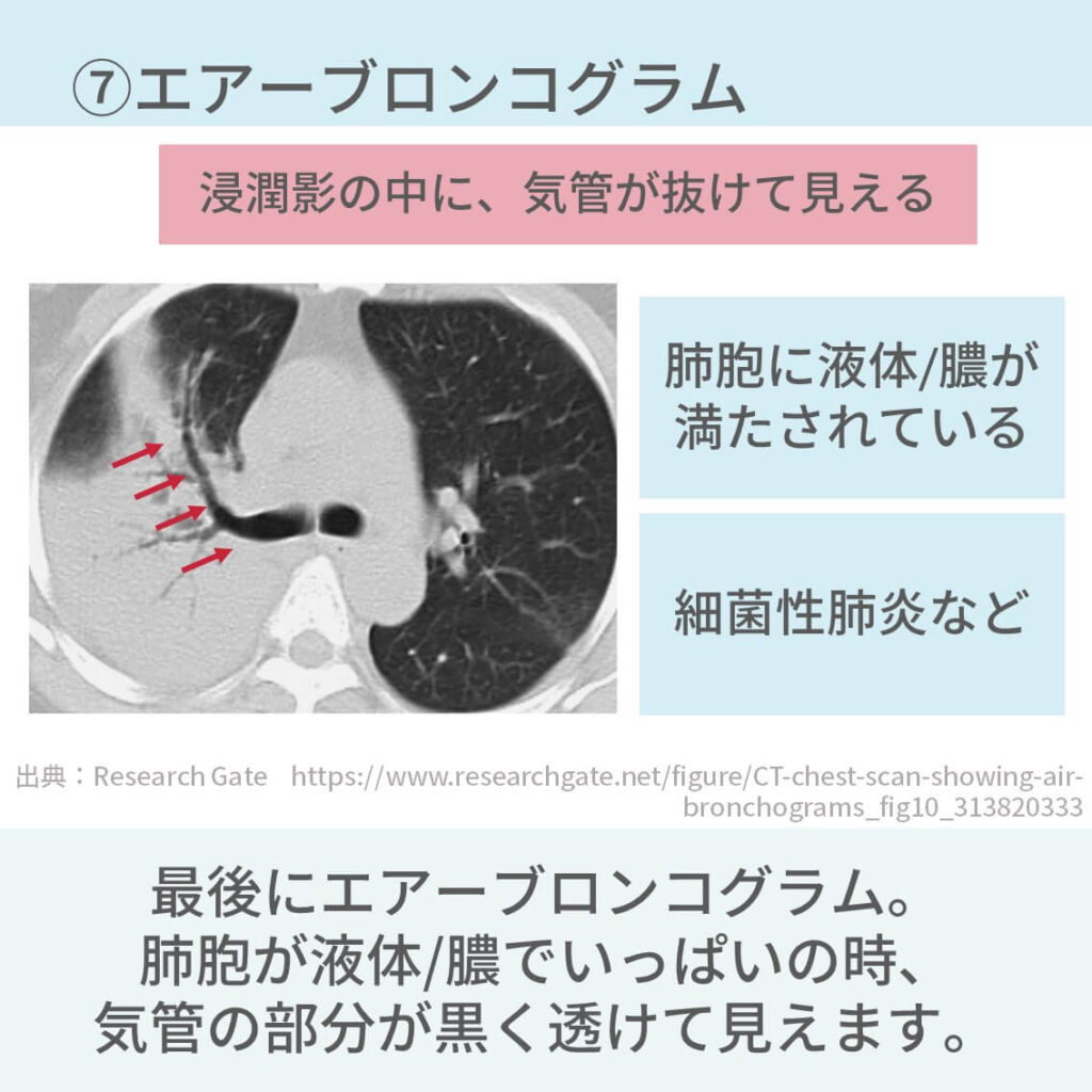 胸部CT、間質性肺炎、びまん性肺疾患