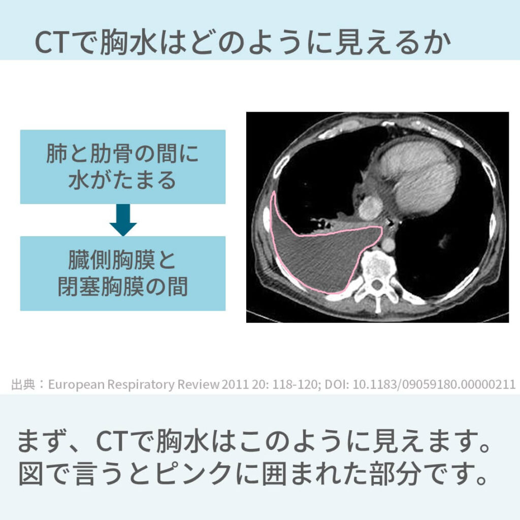 胸部CT、胸水