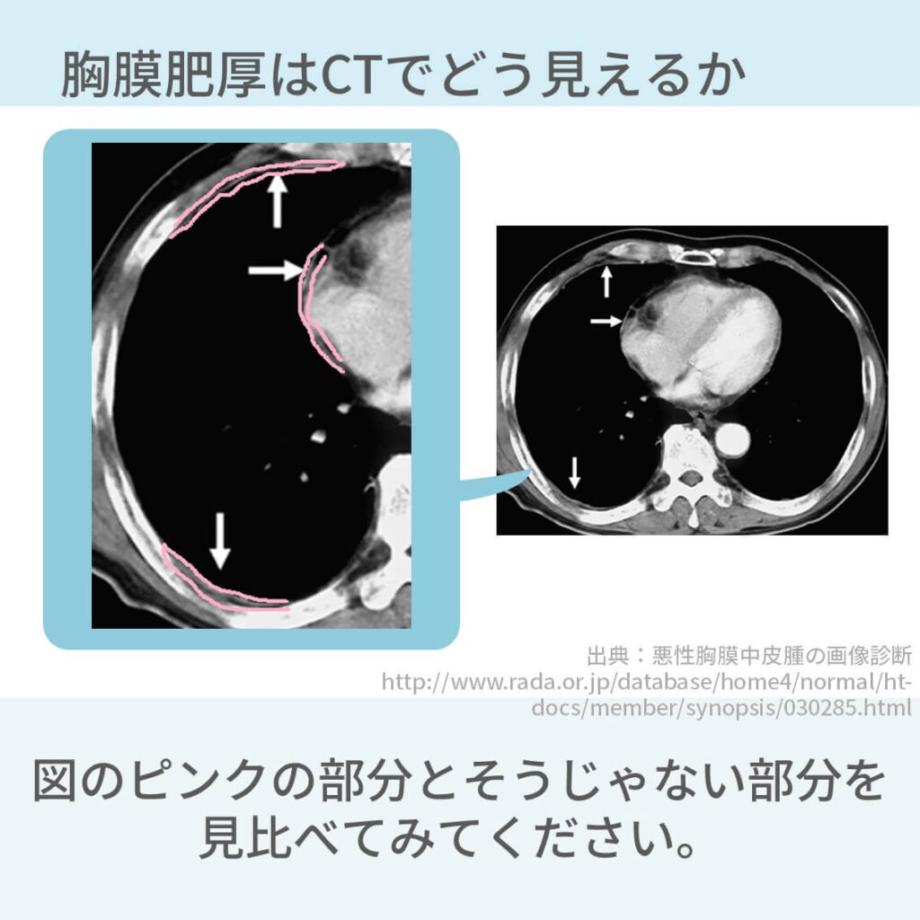 胸部CT、胸膜肥厚