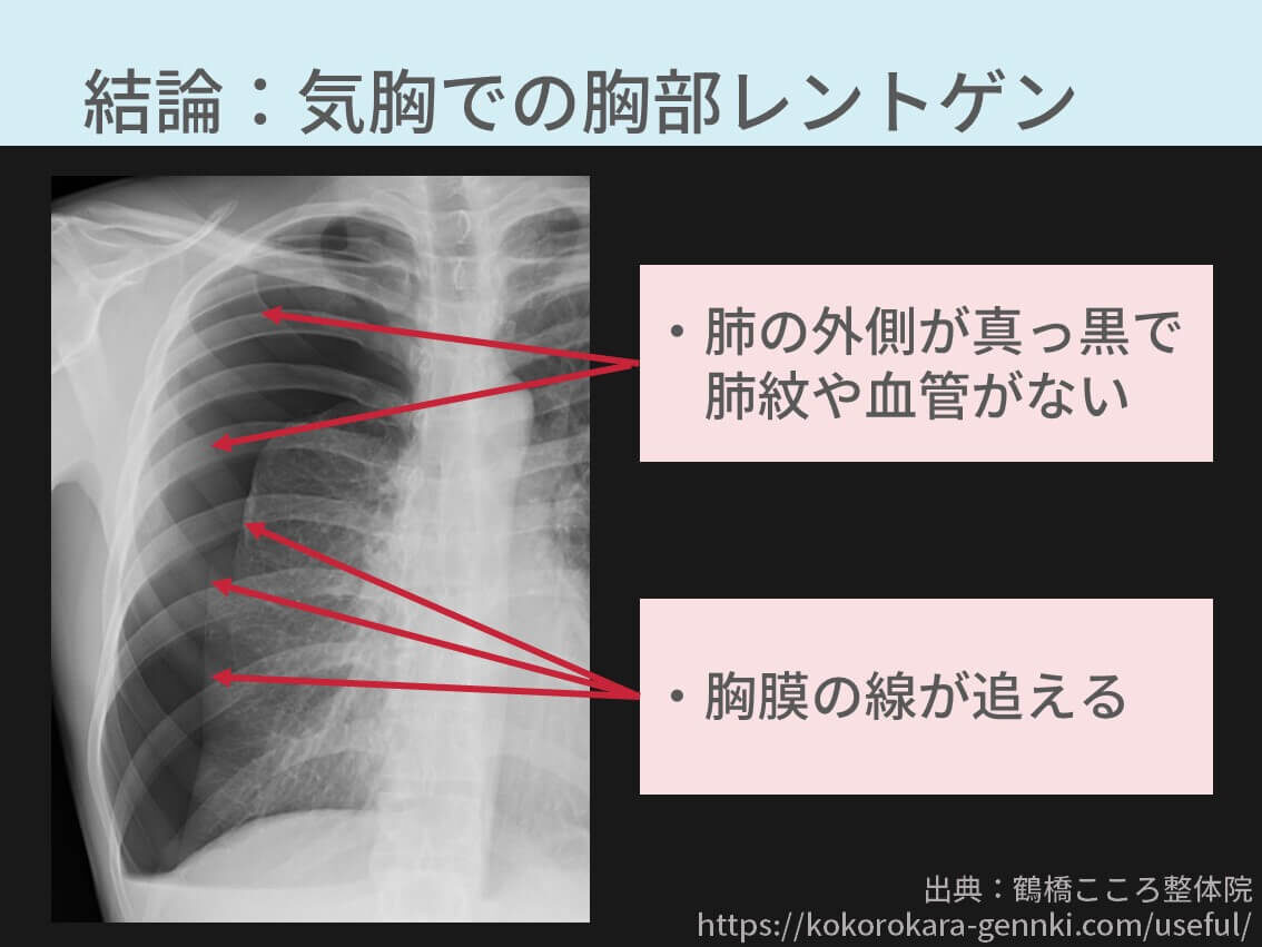 気胸 レントゲン