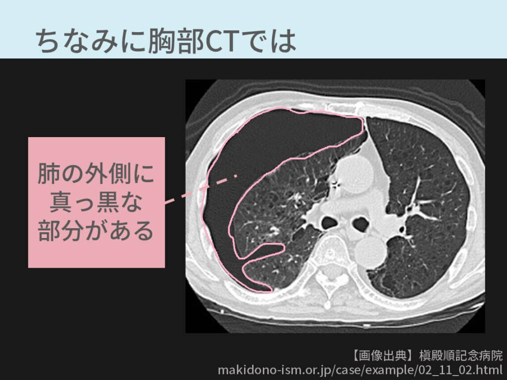 肺野と肋骨の間に真っ黒な胸腔がみえます。