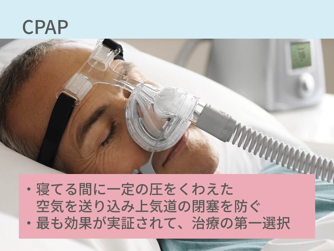 睡眠時無呼吸症候群　CPAP　治療　口腔内装置　体位療法　減量療法　手術