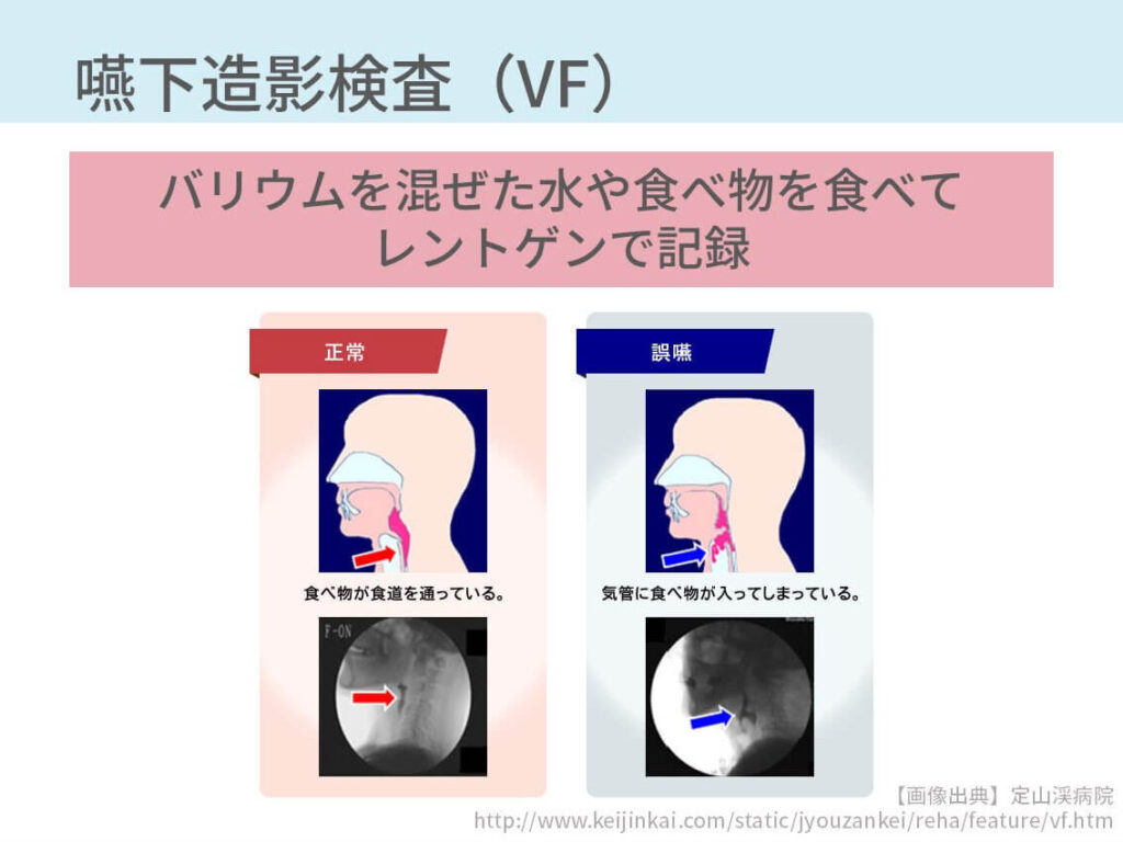 Vorlage: 嚥下造影検査(Videofluoroscopic examination of swallowing; VF) 嚥下造影検査(Videofluoroscopic examination of swallowing; VF) Bildidee
