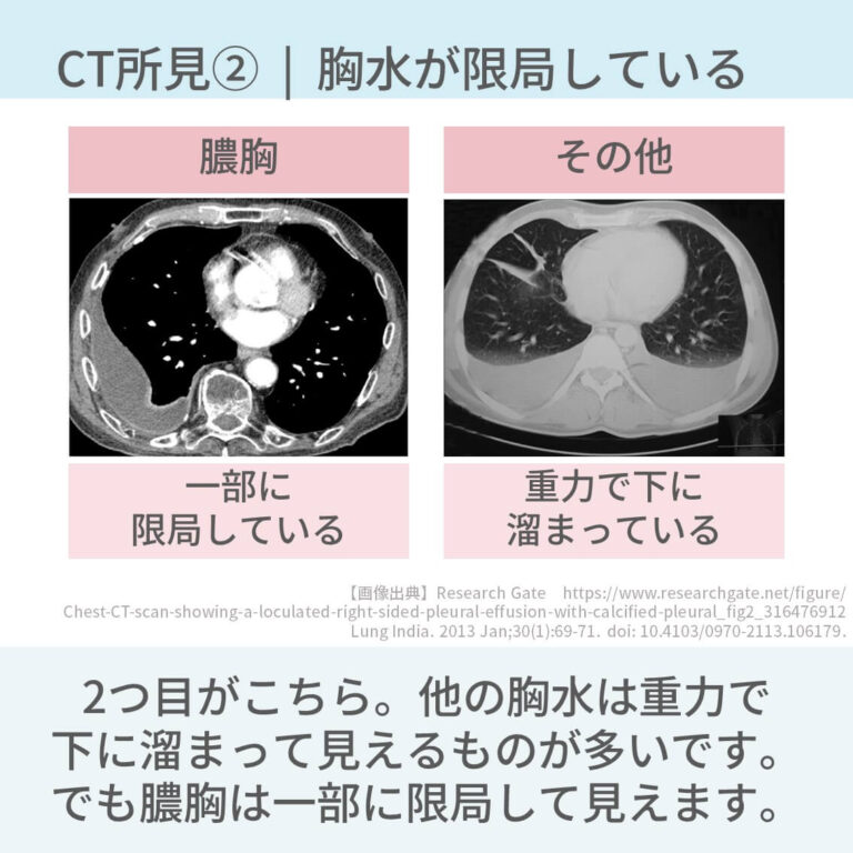 胸水のCT所見は別記事[ 胸部CTでの胸水の特徴と鑑別疾患を解説【胸膜 …