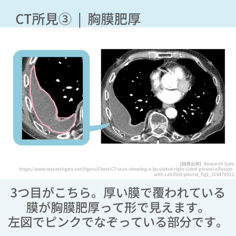 胸水のCT所見は別記事[ 胸部CTでの胸水の特徴 …