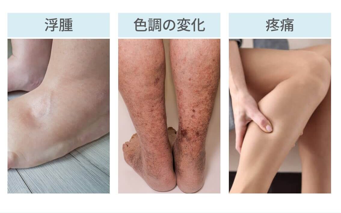 静脈血栓症の症状