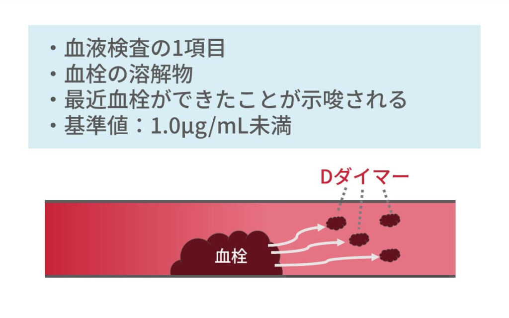 深部静脈血栓症手術原因: 深部静脈血栓症 手術 リスク – BSKRS