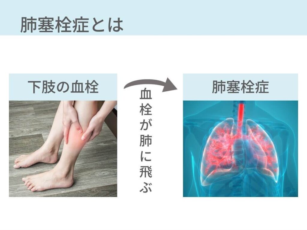 肺血栓塞栓症(PTE)と深部静脈血栓症(DVT)は一連の病態だったりします。なのでこれらをまとめて、静脈血栓塞栓症(VTE)と総称します。